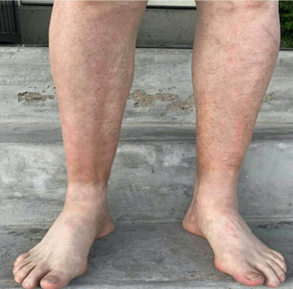 Example of stasis dermatitis