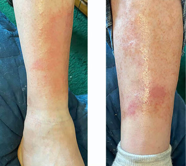 Example of stasis dermatitis on two different legs